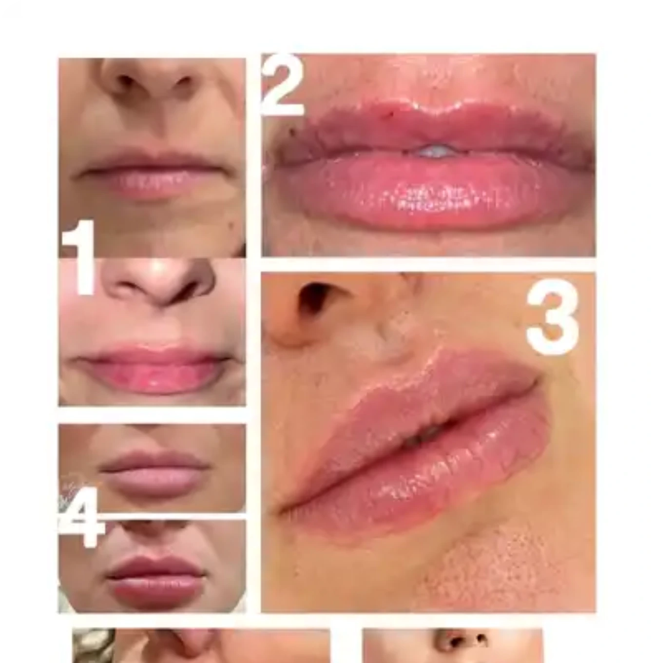 A woman 's lips are shown with different stages of lip augmentation.