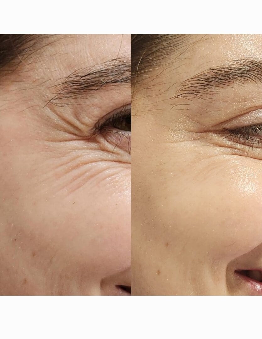 IMG_20250102_124209 Before and after skin treatment comparison.