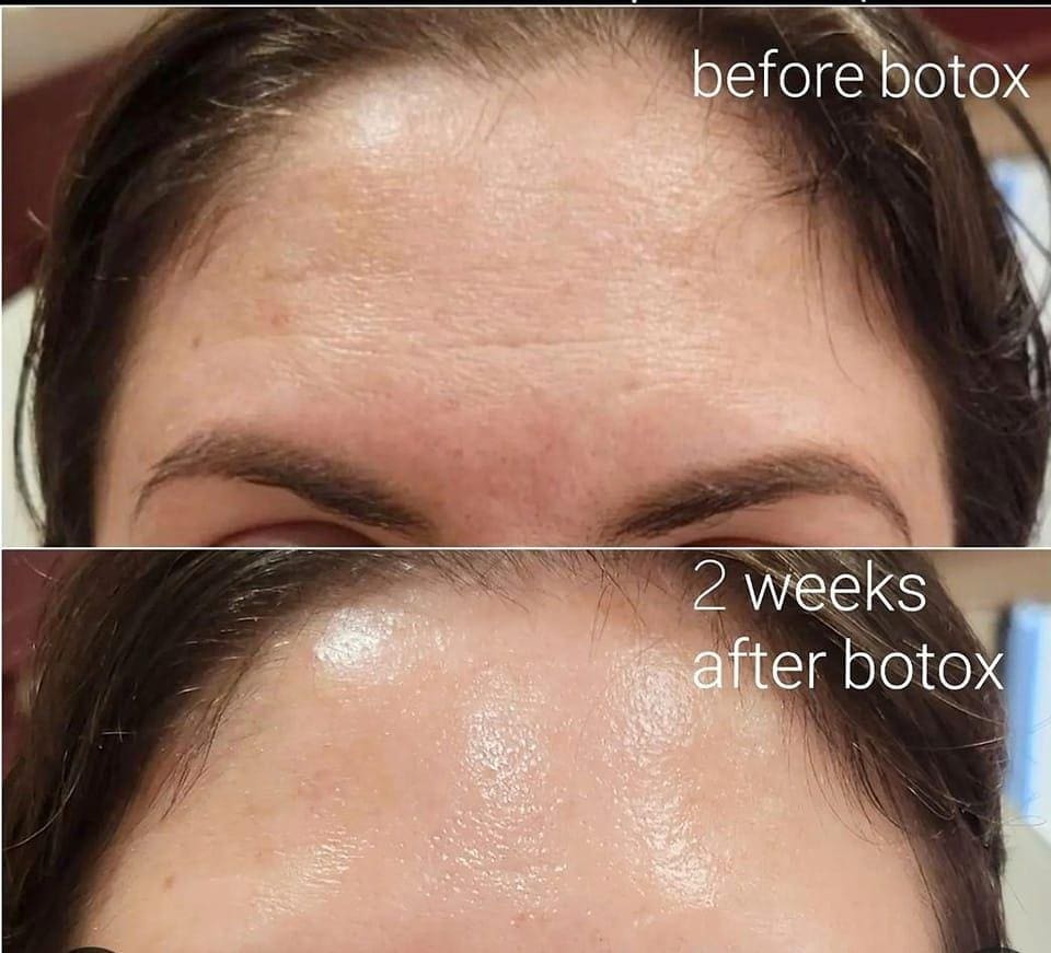 Botox Results: When They Start and How Long They Last