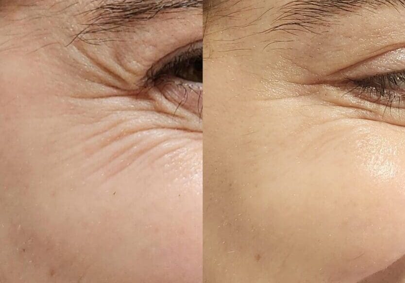 Before and after skin treatment comparison.