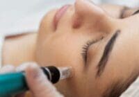 person-getting-micro-needling-beauty-treatment